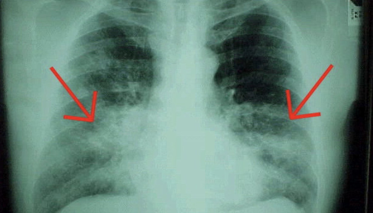 Fibrosi polmonare, malattia rara che necessita di diagnosi precoce e centri di eccellenza
